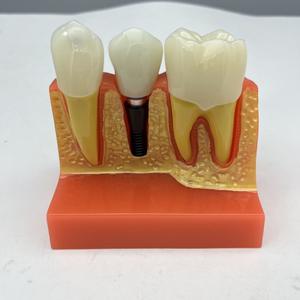 Medische Wetenschappelijke Lesapparatuur Leermodellen Tandheelkundige Typodont Menselijke Tanden Modelpraktijk Tandheelkundig Implantaatmodel - Product Image 4