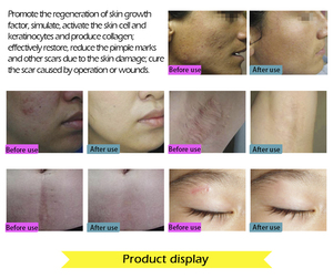 Venta al por mayor de cicatrices quirúrgicas Embarazadas Estiramiento de marcas de acné Reparación de cicatrices Gel eficaz s cicatriz antigua en gel de eliminación de reparación de la piel - Product Image 4