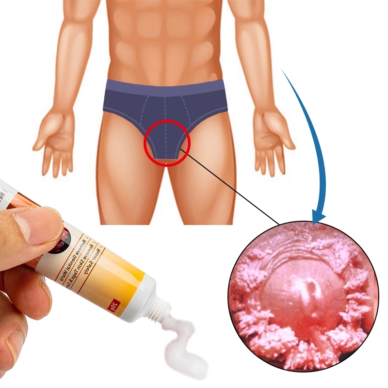 KanyeHB Wart Ointment Genital Herpes Genital Vulva Condyloma Acuminatum Skin Tag Antibacterial Cream