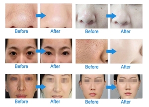 Appareil de soin du visage par hydrodermabrasion et oxygène avec effet tenseur et éclaircissant <span class=keywords><strong>pour</strong></span> usage commercial en spa - Product Image 6