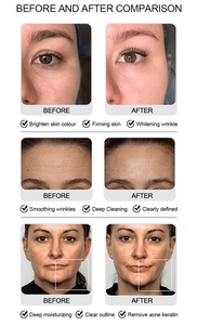 6 in 1 다기능 피부 관리 기기, 페이셜 클렌징, 진공 테라피, 제트 필링, 더마브레이션, 각질 제거 - Product Image 6