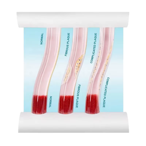 Comparaison de démonstration du flux de cohérence sanguine dans le PVC Modèle de blocage dynamique des vaisseaux de l'hyperlipidémie humaine pour la science médicale - Product Image 5