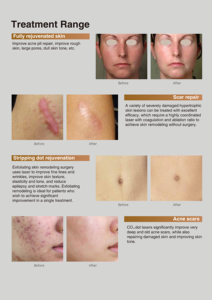 เครื่องเลเซอร์ CO2 แบบ Fractional สำหรับการรักษาทางการแพทย์ขั้นสูง เหมาะสำหรับคลินิกความงามมืออาชีพ - Product Image 6