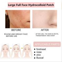 Patchs Hydrocolloïdes OEM Grande Taille pour le Visage – Patchs Anti-Acné Matifiants Grand Format pour Toute la Face – Bande Adhésive Invisible pour Couvrir les Points Noirs – Patchs Anti-Acné Personnalisables