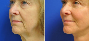 Resultado efectivo 980 + 1470nm Endolaser Máquina Lipólisis Fibra óptica Estiramiento facial para belleza y pérdida de peso - Product Image 2