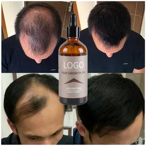 Custom Private Label Scalp Loss Leave In Ginger Biotin Germinal Regrowth Hair Oil Keratin Organic Roller Hair Growth Serum