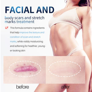 Tratamiento de cicatrices de fórmula avanzada que reduce la apariencia de cicatrices antiguas y nuevas, producto <span class=keywords><strong>para</strong></span> cirugía, lesiones, quemaduras, crema <span class=keywords><strong>para</strong></span> eliminar cicatrices de acné - Product Image 2