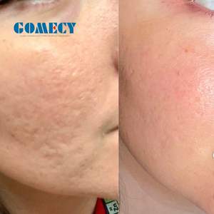 Nouvelle machine de rajeunissement cutané par <span class=keywords><strong>radiofréquence</strong></span> <span class=keywords><strong>fractionnée</strong></span> <span class=keywords><strong>à</strong></span> <span class=keywords><strong>micro</strong></span>-<span class=keywords><strong>aiguilles</strong></span> dorées, avec aspiration et lifting RF - Product Image 5