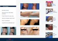 Appareil laser endo 1470 nm pour le lifting et la réduction des rides du visage