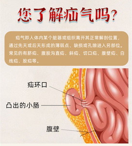 Pegatinas de <span class=keywords><strong>Hernia</strong></span> Bebé <span class=keywords><strong>Hernia</strong></span> <span class=keywords><strong>Umbilical</strong></span> Dolor Parche <span class=keywords><strong>Adultos</strong></span> Yeso Productos para el cuidado del bebé - Product Image 4