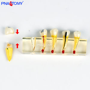 PNATOMY, modelo terapéutico patológico Dental de 5 componentes, muestra lesiones de caries, pulpa necrótica, absceso apical de plástico - Product Image 6