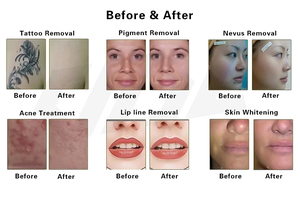 Máquina Facial 9 en 1 de Microdermoabrasión Hydra con Oxígeno y 9 Manijas para Rejuvenecimiento, Reafirmación y Blanqueamiento de la Piel (Usado) - Product Image 2