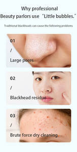Limpiador de piel de microespuma, todo incluido, compresa caliente, masaje, limpieza de poros, instrumento con succión de espinillas para todo tipo de piel - Product Image 5