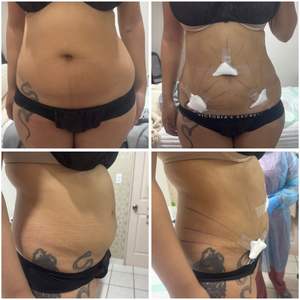 Máquina Láser de Endolifting de Doble Longitud de Onda 980nm 1470nm para Lifting Facial, Eliminación de Grasa y Reafirmación de la Piel - Product Image 5