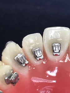 Sản Phẩm Nha Khoa Hot Niềng Răng Cho Niềng Răng Tự Chỉnh Nha DTC - Product Image 3