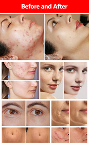 เครื่องเลเซอร์ CO2 กำลังสูงสำหรับกระชับช่องคลอด เลเซอร์ CO2 แบบ Fractional สำหรับฟื้นฟูผิวหน้า เครื่องมือเสริมความงาม ปรับขนาดจุดเลเซอร์ได้ - Product Image 5