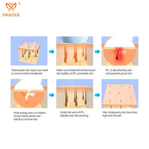 Épilateur IPL permanent professionnel à cinq niveaux pour un usage domestique Dispositif d'épilation au laser électrique indolore avec rajeunissement de la peau - Product Image 2