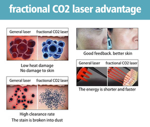 Máquina de Láser Fraccional de CO2 de 60W para Cuidado Personal, Eliminación de Cicatrices, Pecas y Acné con Peeling para Corte Láser, Máquina de Láser Fraccional de CO2 - Product Image 5