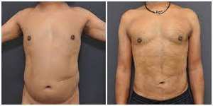 جهاز ليزر عالي القدرة 60 واط بطول موجة 980 نانومتر لإزالة الدهون وشفط الدهون من الذقن المزدوجة وتحفيز التمثيل الغذائي ورفع البشرة - Product Image 4