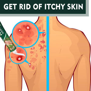 Crème pour le psoriasis à action rapide, marque privée, soulage rapidement les démangeaisons de la peau, répare la peau, onguent pour les mains et les pieds, traitement externe antifongique, crème - Product Image 3