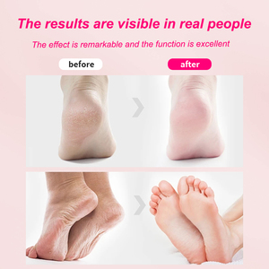 Crème Pieds Naturelle <span class=keywords><strong>Anti</strong></span>-<span class=keywords><strong>Callosités</strong></span> à 42% d'Urée, Vitamine C et Acide Salicylique – Soin Hiver Peaux Sèches et Craquelées – Meilleure Vente - Product Image 5