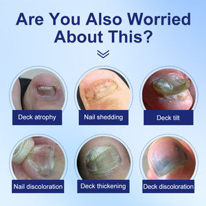 Traitement Liquide Extra Fort Contre la <span class=keywords><strong>Mycose</strong></span> des Ongles 25% Acide Undécylénique, Soin <span class=keywords><strong>Antifongique</strong></span> pour Ongles des Pieds et des Mains à l'Huile d'Arbre à Thé pour la Peau des Pieds - Product Image 6