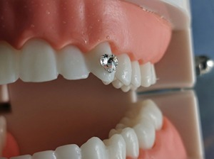 Gioielli Dentali a Forma di Cuore in Cristallo - Gemme Dentali Premium per un <span class=keywords><strong>Sorriso</strong></span> Scintillante, Gioielli in <span class=keywords><strong>Stile</strong></span> Hip Hop Punk - Product Image 4