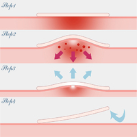 Patch hydrocolloïde pour boutons d'acné de conception unique pour plus de confort