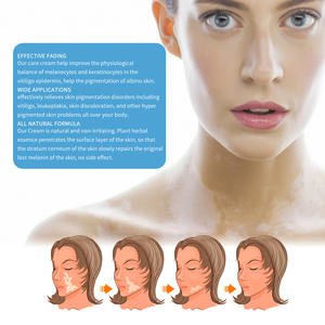 Tratamiento para el Vitiligo South Moon, Hierbas Naturales, Crema SM-046, Elimina Manchas Blancas, Tiña, Leucoplasia, Dermatitis, 20 ml - Product Image 6