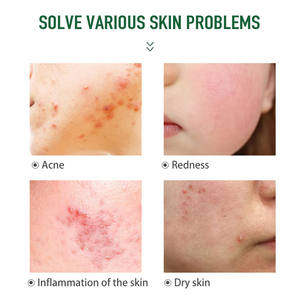 ครีม<span class=keywords><strong>รักษา</strong></span><span class=keywords><strong>สิว</strong></span>ผสมกลีเซอรีน น้ำมันทีทรี และมอยเจอร์ไรเซอร์บำรุงผิวหน้า <span class=keywords><strong>ส</strong></span>ำหรับรอย<span class=keywords><strong>ส</strong></span>ิว แผลเป็นจาก<span class=keywords><strong>ส</strong></span>ิว <span class=keywords><strong>รักษา</strong></span><span class=keywords><strong>สิว</strong></span>ชนิดต่างๆ - Product Image 4