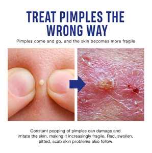 QBEKA Crema para el Tratamiento del Acné, Crema Facial para Marcas de Acné, Reduce los Poros, Hidrata la Piel - Product Image 6