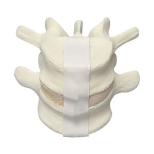 <span class=keywords><strong>Vertebra</strong></span> lombare <span class=keywords><strong>L4</strong></span> e L5 in schiuma solida KyrenMed modello osseo per la formazione in officina di ortopedia avvitamento e placcatura - Product Image 2