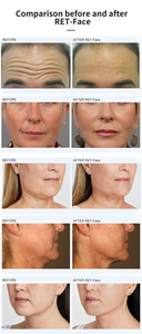 High Quality Face and Neck Lift Massager Increase Collagen and Elastin Anti-aging Anti-wrinkle <b>Skin</b> Rejuvenation Beauty <b>Machine</b> - Product Image 6