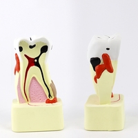 Modèle d'anatomie dentaire complet : Profil de pathologie de la carie dentaire – Produit scientifique médical