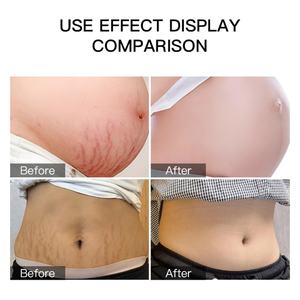 Gel Réparateur Cutané Efficace aux Herbes, Crème Raffermissante Corps Anti-Vergetures et Cicatrices pour la Grossesse - Product Image 3