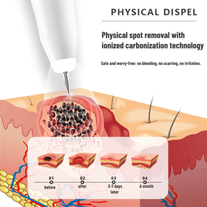 Instrument de beauté deuxième spot de peau indolore de stylo de balayage de grain de beauté - Product Image 6