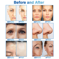 Meilleur 15 en 1 Hydra Dermabrasion Machine avec Jet D'oxygène Peel Microdermabrasiondeep nettoyage hydra dermabrasion machine pour spa