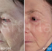 Appareil de liposuccion Vaser à laser 980nm 1470nm pour la chirurgie endolaser par fibre optique, machine de beauté pour l'élimination des graisses en salon