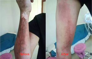 Nouvelle conception, pas d'anesthésie et récupération rapide, <span class=keywords><strong>machine</strong></span> de beauté pour lifting du visage à usage domestique ou commercial - Product Image 5