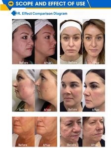 2026 Microneedle Fractional Skin Tightening <strong>Machine</strong> Acne Treatment Scar Removal Rf <strong>Microneedling</strong> <strong>Machine</strong> - Product Image 3