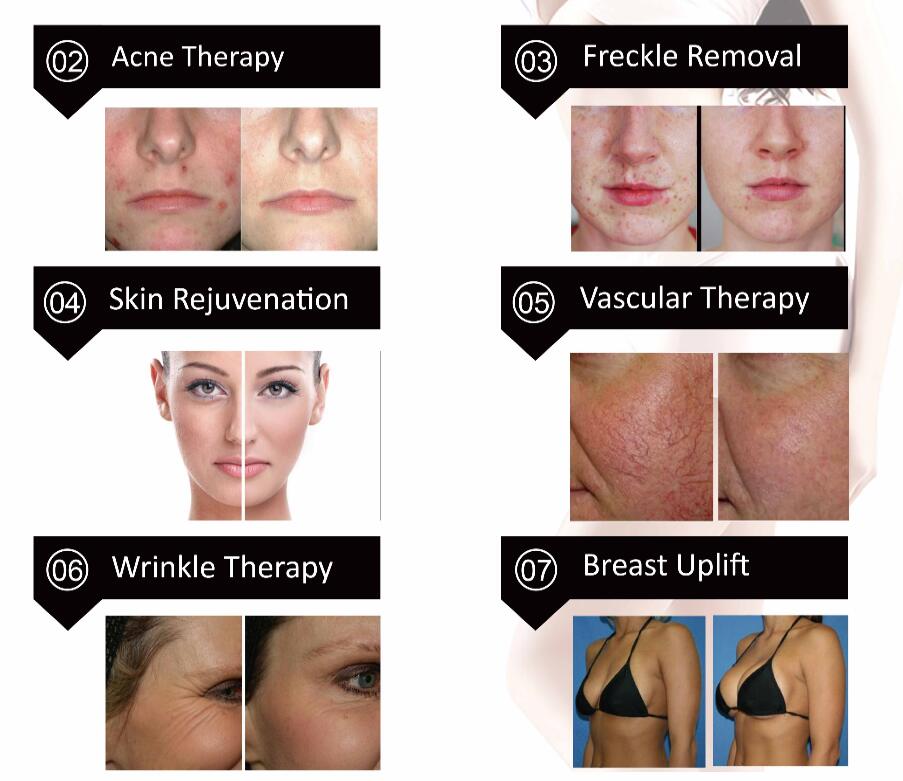 Super Nano Light OPT SHR IPL for hair removal/skin rejuvenation/Vascular Therapy & Breast lift