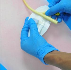 Perlengkapan Medis Jarum Indwelling Perangkat Pengaman Tabung Nasogastrik Sekali Pakai Perangkat Fiksasi Kateter Kustom - Product Image 1