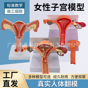 Modèle utérin pathologique féminin ; structure anatomique de l'ovaire et de l'utérus en obstétrique et gynécologie ; avancé - Product Image 5