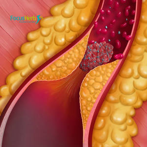 FocusHerb Fábrica, Venta al por Mayor Personalizada de Polvo de Nattoquinasa de Alta Calidad, 20000FU/g - Product Image 3