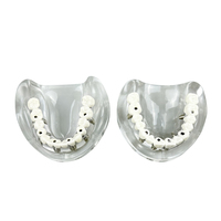 Modelo Anatómico de Implante Dental, 6 Implantes, Mandíbula Superior e Inferior, Restauración de Sobredentadura, Dientes Removibles, Educación, Estudio, Enseñanza