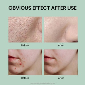 Own Brand Face <strong>Cream</strong> &amp; Lotion for Oily Skin 1-1.5% Benzoyl Peroxide Acne Combination Whitening and Acne <strong>Scar</strong> Repair - Product Image 6