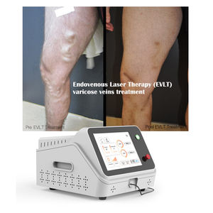 Láser de Diodo Endovenoso de Fibra EVLT de 980nm 1470nm para la Eliminación de Arañas Vasculares y Venas Varicosas - Product Image 3