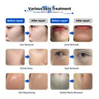 Machine de beauté pour le resurfaçage de la peau, l'élimination des cicatrices d'acné et des tatouages, 70W 100W, pour salon et clinique esthétique, laser CO2 fractionné approuvé 510k