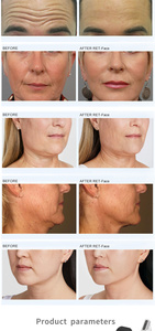 เครื่องยกกระชับใบหน้า RET-Face วัสดุแม่เหล็ก ABS กันน้ำ สำหรับกระชับผิว ลดริ้วรอย และฟื้นฟูผิว - Product Image 5