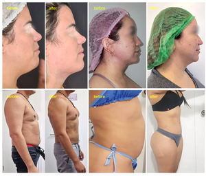 Laser Diode medis bedah sedot lemak profesional, mesin penghilang berat badan serat lipolisi 980nm + 1470nm - Product Image 5